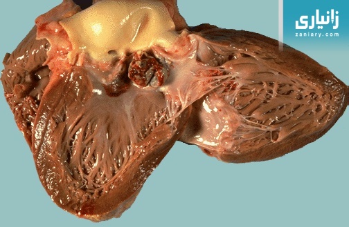 هەوی ناوپۆشی دڵ-ئێندۆکاردیت (Endocarditis)